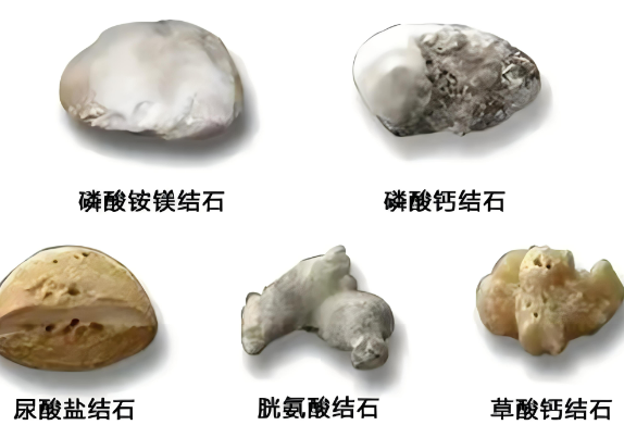 杭州体外碎石医院有几家？【24小时碎石】(5)