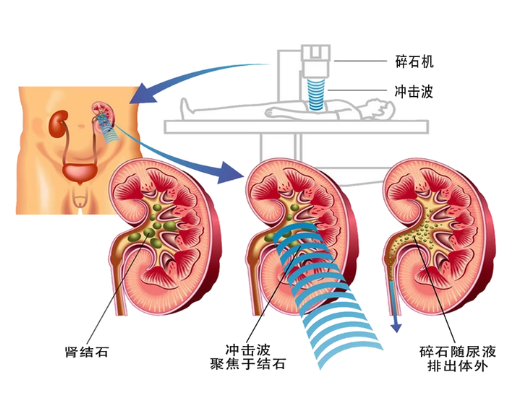 杭州体外碎石医院电话号码多少？【24小时碎石】(10)